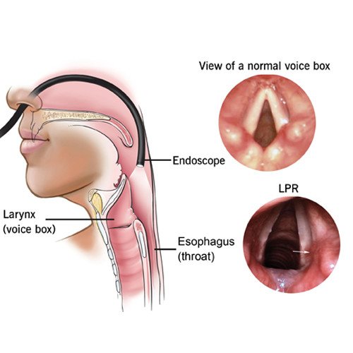 laryngeal endoscopy in Puri